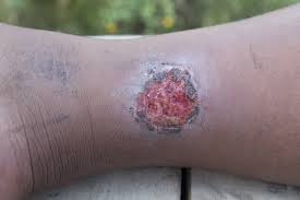 • a change in skin color on your leg or foot— reddish blue when. 529 Best Gangrene Images Stock Photos Vectors Adobe Stock