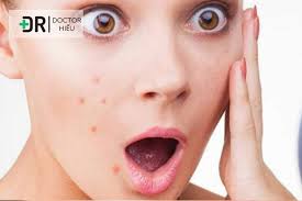 Nóng Gan có phải NGUYÊN NHÂN của Mụn nội tiết