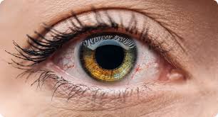 Image result for Dry Eye