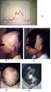 This includes eyebrows, eyelashes, arms, legs, underarms, pubic, and chest and back hair for men. Herb Lotions To Regrow Hair In Patients With Intractable Alopecia Areata
