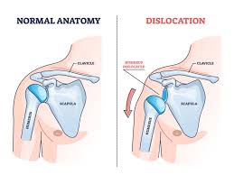 Image result for Chronic Shoulder Dislocation