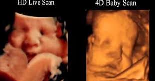 Pin On 4d Ultrasound