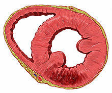 Le gain de survie est d'autant plus important que le. Infarctus Du Myocarde Wikipedia