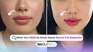 What You NEED to Know About Buccal Fat Reduction!