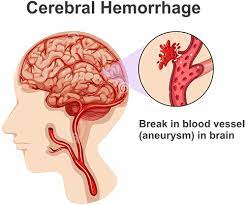 A doctor may inject a dye into the brain's blood vessels to make them visible. Brain Stroke Stem Cell Therapy