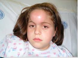 I am having nasal vestibulitis. H P Nose Flashcards Quizlet