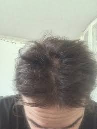 When the estrogen hormone levels tend to drop, the hair follicles fall under the influence of the male sex hormone or the testosterone, which cause the shortening of the growth phase of hair. I Got My Hair Back Thanks To Estradiol Hairlosstalk Forums
