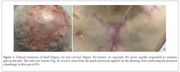 Image result for Pathergy