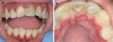 Gingivostomatitis is a combination of gingivitis and stomatitis, or an inflammation of the oral mucosa and gingiva. Oral Ulcers Pocket Dentistry