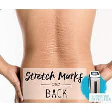 It requires only a brief recovery period while still providing powerful results. Treatment Voucher Stretch Marks Removal Back With Er Q Switched Yag Laser