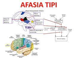 Check spelling or type a new query. Il Paziente Afasico Cause Di Afasia