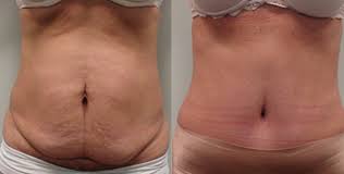 Maybe you would like to learn more about one of these? Tummy Tuck Inland Empire Abdominoplasty Tummy Tuck Surgeon