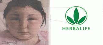 HERBALIFE”-ын LINE бэлдмэл уусан бүсгүйн бөөр нь үхжиж, үхлийн ирмэгт байна