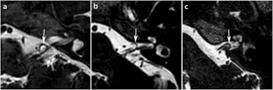 I can't feel a difference for good in my tinnitus at all, it just hey does that finger tapping reddit thing work for you? Typewriter Tinnitus Revisited The Typical Symptoms And The Initial Response To Carbamazepine Are The Most Reliable Diagnostic Clues Scientific Reports