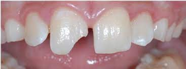 When I Was 13 15 I Spent A Lot Of Time On A Horse Walking Trotting Cantering Galloping And Racing All Over Chipped Tooth Repair Chipped Tooth Tooth Repair