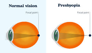 Image result for Presbyopia