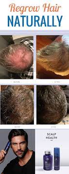 How Do These Men Regrow Hair Get Natural Results Without Harsh Chemicals To Get Results Like These N Hair Growth For Men Regrow Hair Regrow Hair Naturally