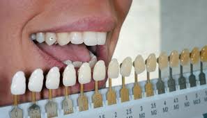 how to choose your teeth colour choosing teeth shades