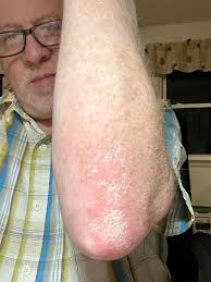 Side affects of ultraviolet phototherapy?