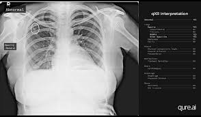 That ranks as the no. These Algorithms Could End The Scourge Of Tuberculosis The New York Times