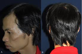 Results after four years of follow-up: (A) Right view (B) Posterior view.