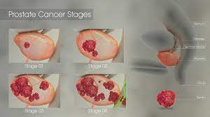 Prostate cancer is the most common cancer among men. Prostate Cancer Symptoms Causes And Treatment Scientific Animations