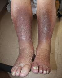 Image result for Lipodermatosclerosis