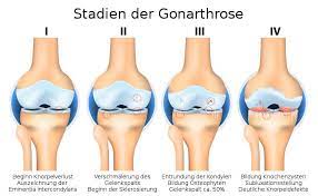 Gonarthrose Schmerzfrei Mit Der Richtigen Therapie