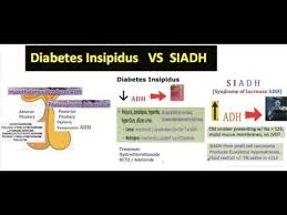 Videos Matching Siadh Vs Diabetes Insipidus Revolvy