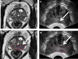 Prostate Magnetic Resonance Imaging For Brachytherapists Anatomy And Technique Brachytherapy