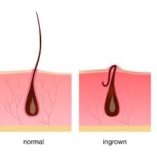 Razor bumps and ingrown hairs start with a genetic tendency towards extremely curly hair. Take On Your Worst Shaving Issues Razor Burn Vs Ingrown Hairs Vs