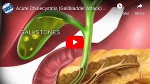 How can i reduce my risk for gallstones? Gallbladder Surgeon In Novi Mi Rb Kolachalam Md