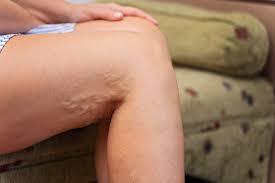 A trombose é a formação de um coágulo sanguíneo em uma veia, geralmente das pernas. Trombose Reducao De Atividade Fisica E Fator De Risco Para Doencas Vasculares