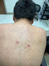 Image result for Lymphoma