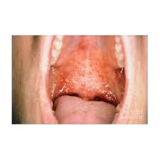 Image result for Oral herpes roof of mouth