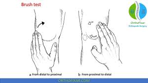 Image result for Ballottable Patella Sign