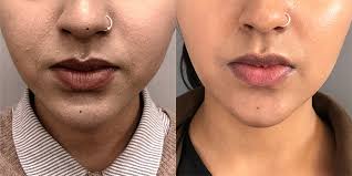 Find doctors near you what affects the cost of buccal fat removal? Buccal Fat Removal Cheek Contouring From 111 Harley St