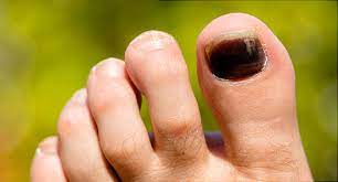 Most melanomas are either brown or black. Black Toenail Cancer In North Texas Graff Foot Ankle And Wound Care