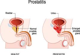 Prostataentzundung Prostatitis Ursachen Symptome Behandlung Medlexi De