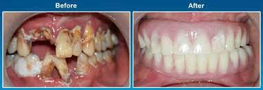 Before And After Image Dental Implants Case Smile Story 1 Bad Teeth Implants Dental