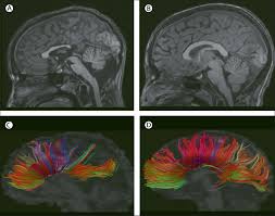 Clinical Presentation Diagnosis And Management Of Fetal Alcohol Spectrum Disorder The Lancet Neurology