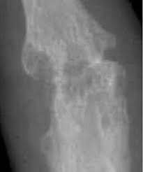 Arthropathy Wikipedia