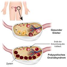 It is a hormonal disorder commonly affecting women of reproductive age. Pco Syndrom Ursachen Beschwerden Therapie Gesundpedia De