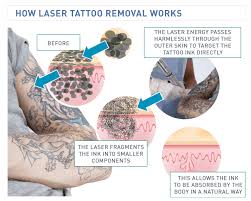 But it does work, very very painful to do thick black hair at first then gets easy. Laser Tattoo Removal Empire Beauty