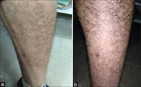 Somewhat commonly, on the legs, blood can leak out of the small capillaries in a cayenne pepper color pattern in a as frustrating as these purpuric spots are, there unfortunately are no good treatments available. Schamberg S Disease A Forgotten Dermatoses A Case Report With Review Mohanty P Hota A Chakraborty K Mohapatra D J Ntr Univ Health Sci