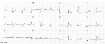 Image result for Right Bundle Branch Block