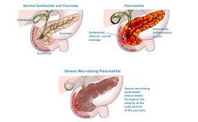 Pancreatic disorders
