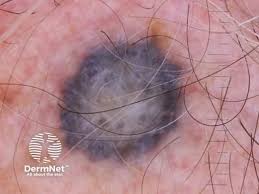 Image result for Blue Nevus