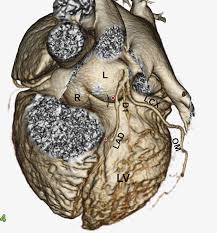 Left anterior descending artery d1: Number Of Diagonal Arteries Coronary Artery Bypass Surgery Heart Bypass Redirects Here