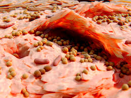 Image result for Neurodermatitis